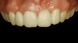 Rekonstrukcija gornjih prednjih zubi